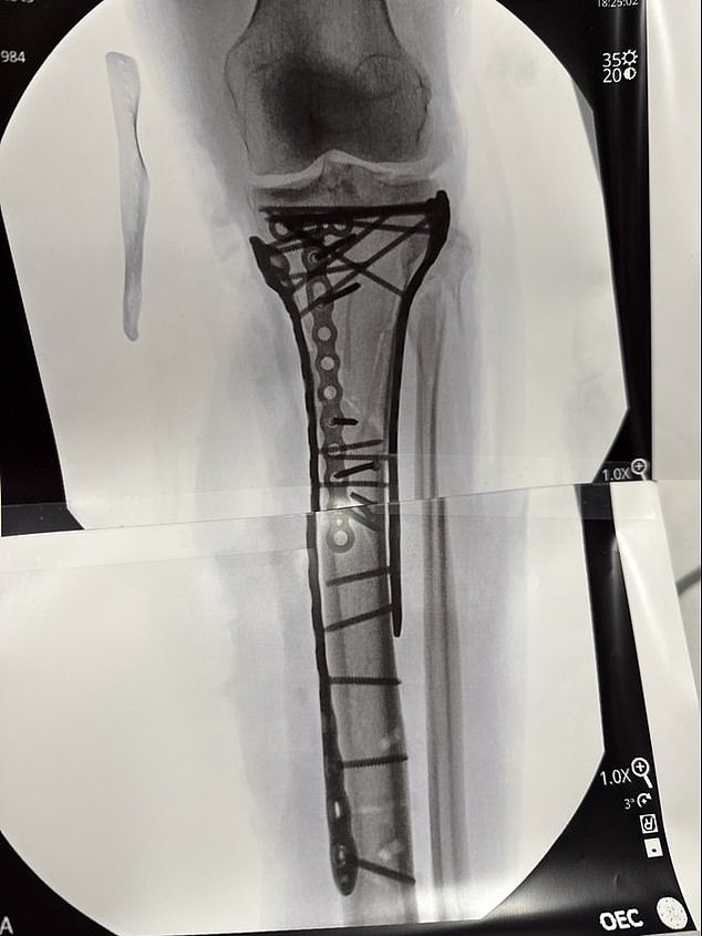 The 41-Year-Old Revealed How Close She Came To Amputation - With Her Leg Now Supported By Dozens Of Metal Pins