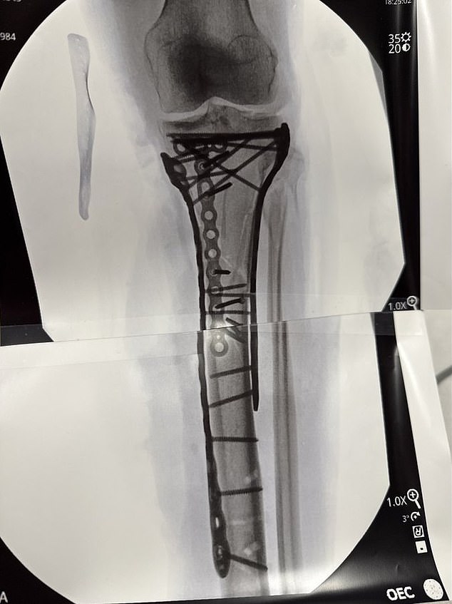 The 41-Year-Old Shared An X-Ray Of Her Surgically-Repaired Leg To Social Media On Friday