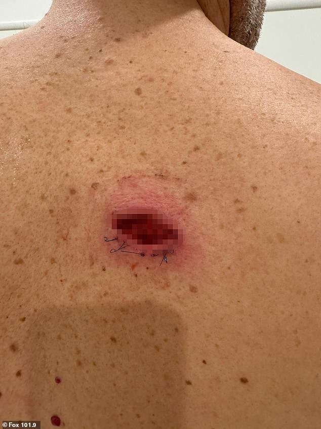 Fevola's Stitches Had Opened Up During A Match - Requiring Him To Go Back To Hospital